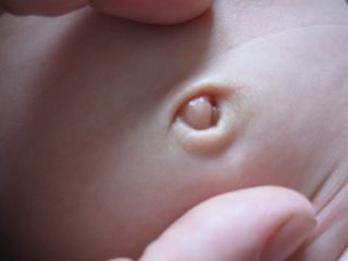 Мокнет пупок у новорожденного и не заживает – что делать и чем лечить?