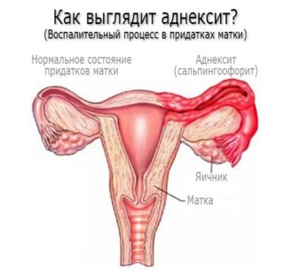 Тянущие боли внизу живота менструация