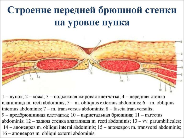 Пупочная грыжа с сальником