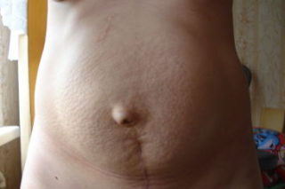 После родов грыжа фото thumbnail