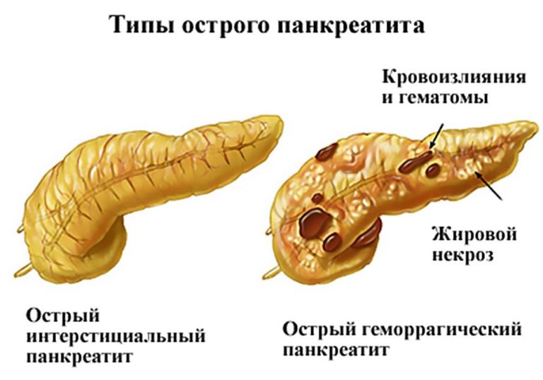 Острый панкреатит картинки