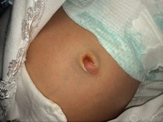Болезни кожи и пупка у новорожденного