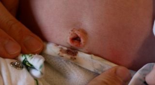 Кровит пупок ребенка 1 год