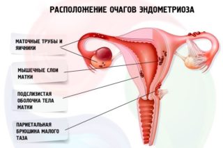 Фиброзная мастопатия молочных желез мкб код