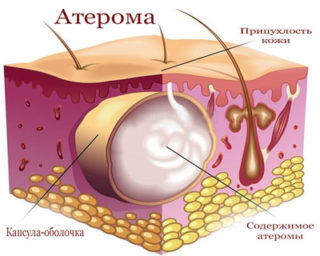 Атерома на груди и болит