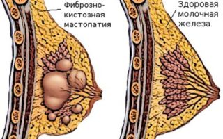 Уплотнение в груди во время месячных