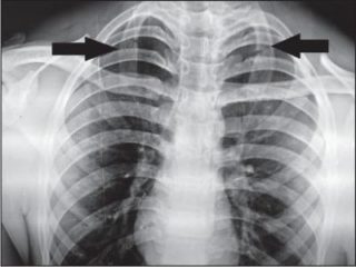 Рентген снимки переломов ребер