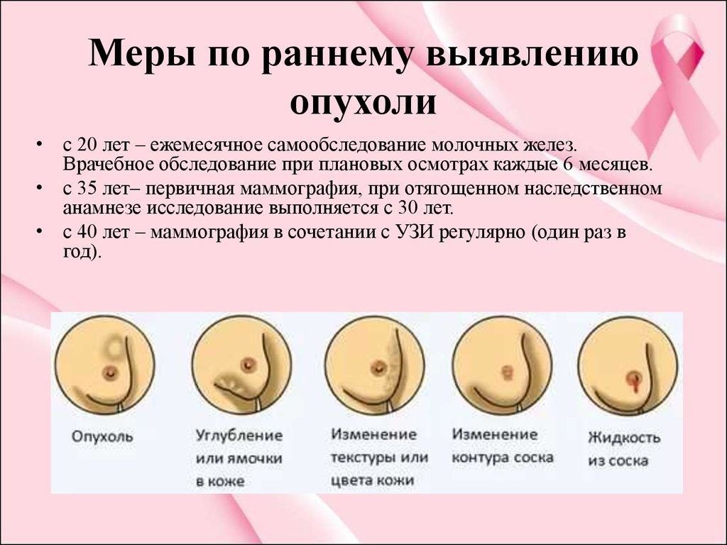 Код мкб образование грудных желез