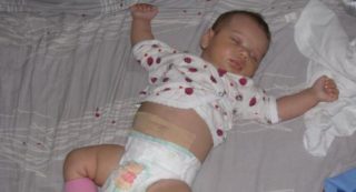 Как заклеить пупочную грыжу у новорожденных обычным пластырем видео thumbnail