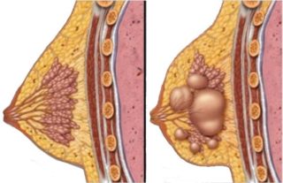 Гиперплазия железистой ткани молочных желез лечение
