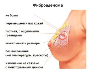 Фиброкистозная мастопатия код мкб