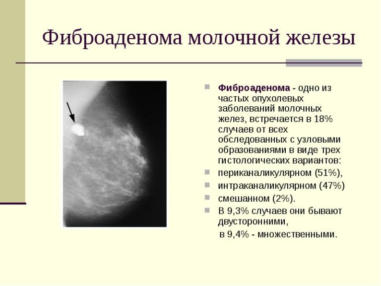 Рак молочной железы симптомы и признаки на ранних фото