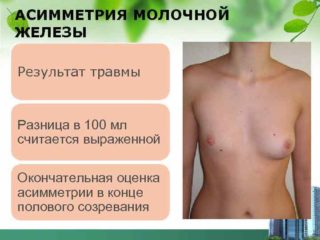 Синдром малой грудной мышцы мкб 10