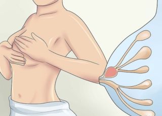 Уплотнение в молочной железе при грудном вскармливании лечение температура