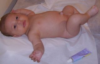 Пояс от пупочной грыжи для новорожденных фото