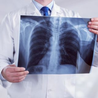 Рентгеновский снимок переломов ребер