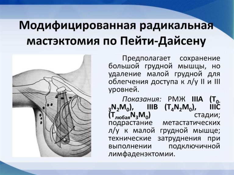 Мастэктомия по маддену фото