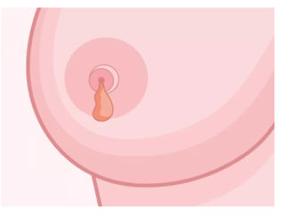 Выделение из желез при мастопатии лечение