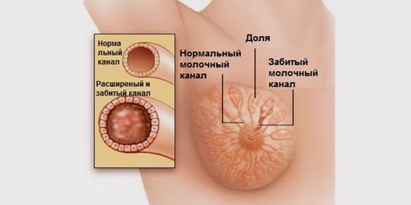 Атерома молочной железы: причины возникновения и что делать