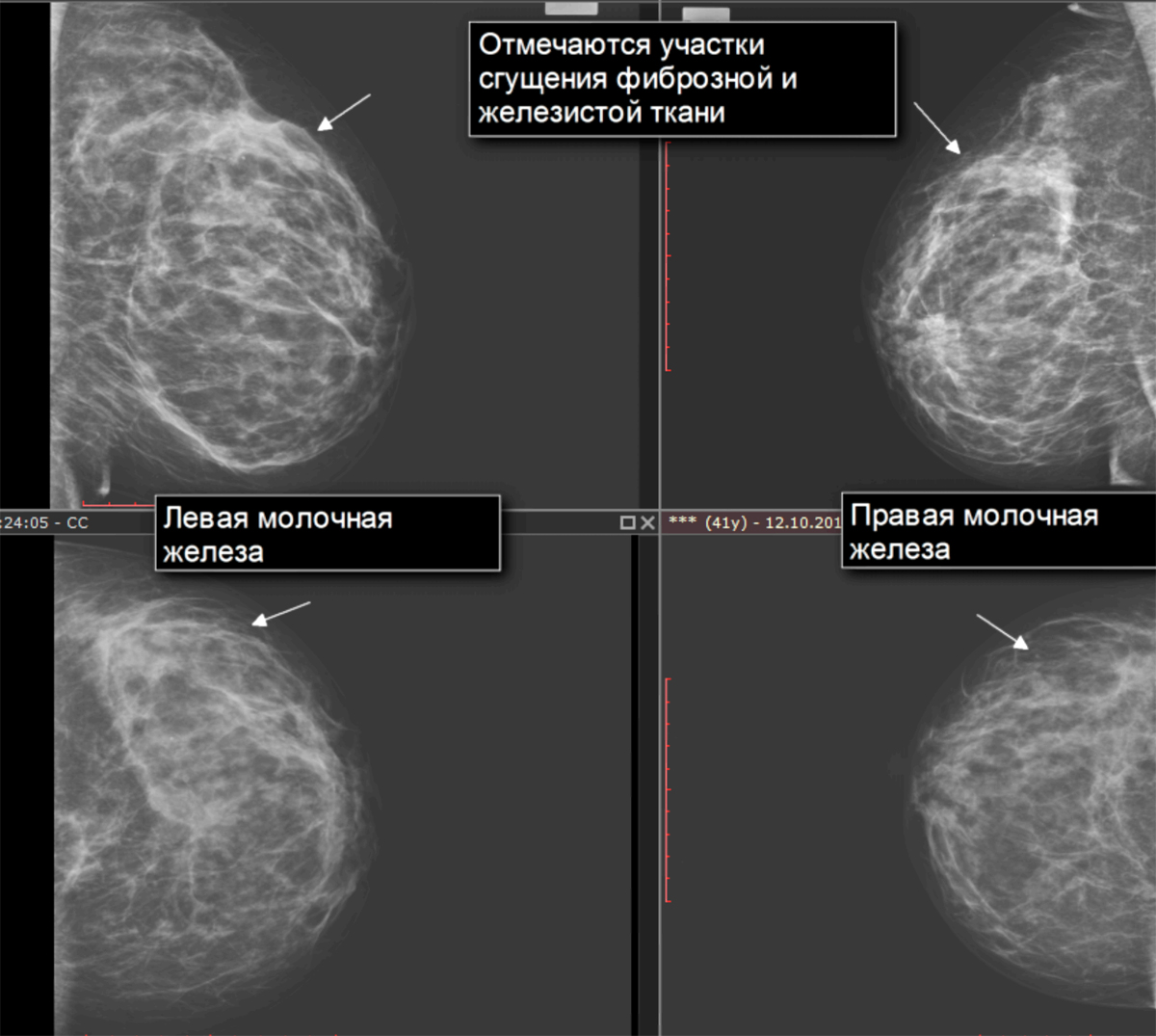 Маммография уплотнения. Фиброзно кистозная мастопатия молочной железы на маммографии. Кистозно фиброзная мастопатия на маммографии. Фиброзно-кистозная мастопатия на кт. Фиброзная мастопатия на маммографии.