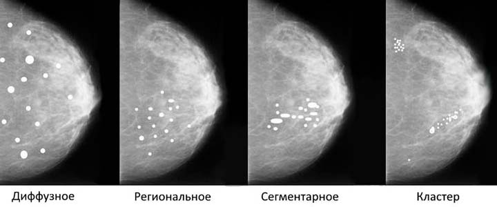 Ореол стал больше. Маммография микрокальцинаты. Фиброзная мастопатия маммограмма. Фиброаденома молочной железы маммограмма. Фиброзно-кистозная мастопатия снимок.