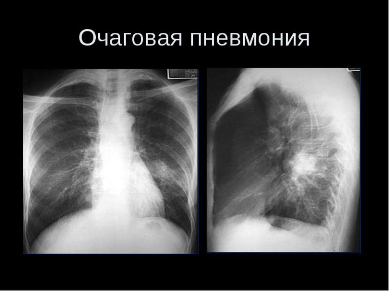 Можно ли делать флюорографию 2 раза в год ответ врача