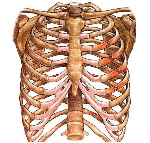 Картинки травма грудной клетки