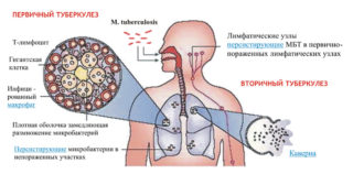 Болит грудная клетка кашель температуры нет