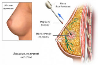 Цистаденопапиллома молочной железы лечение отзывы