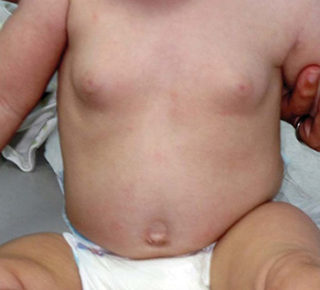 Мастопатия молочных желез у детей лечение