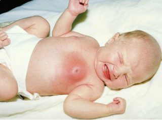Мастопатия молочной железы у новорожденного лечение
