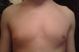 Болит грудь у мальчика 11 лет