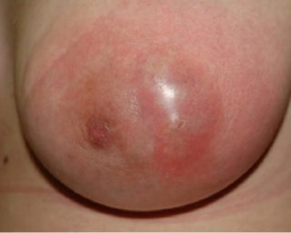 Воспаление грудной железы у женщин лечение что делать