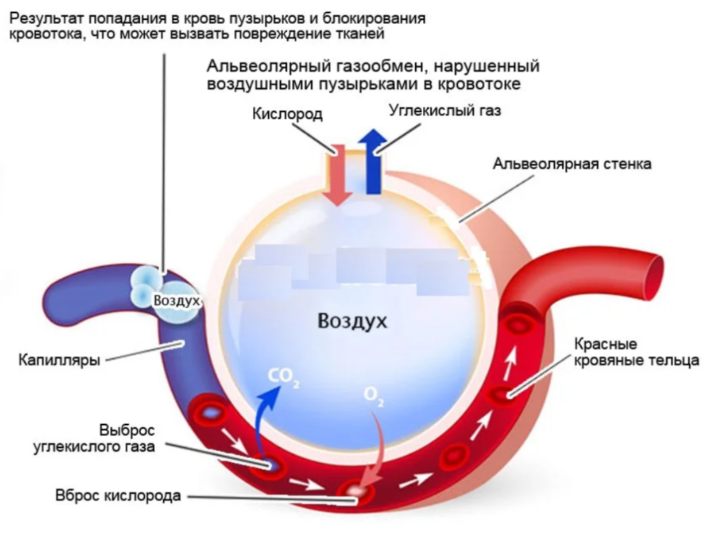 Сосуды газ. Воздушная эмболия механизм развития. Кессонная болезнь воздушная эмболия. Патогенез воздушной эмболии. Воздушная эмболия сосудов.