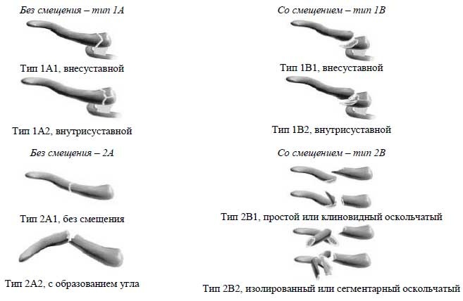 Ключица классификация. Классификация переломов ключицы травматология. Классификация переломов ключицы АО. Классификация перелом ключицы со смещением. Коасиифкация перелов клюциы.