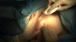 Фиброаденома молочной железы после операции гематома