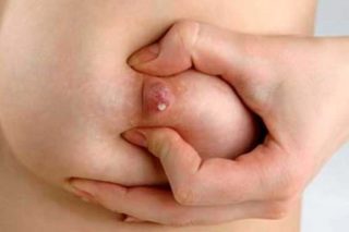 Причины выделений из грудных желез у женщин при надавливании