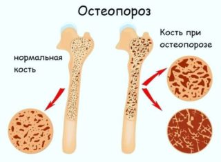 Перелом ключицы спица остеосинтез