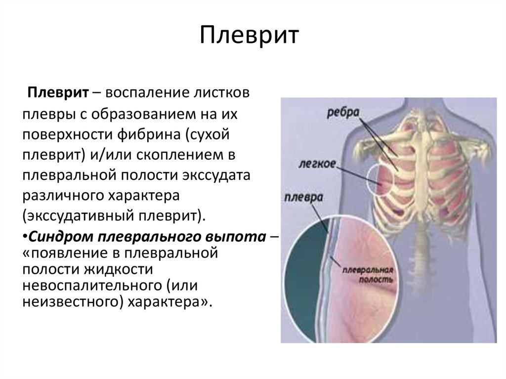 Больно дышать слева. Плевральная боль в грудной клетке. Болит справа в грудине при вдохе. Боль в правой грудине при вдохе.