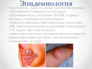 Лечение мастопатии в менопаузе thumbnail