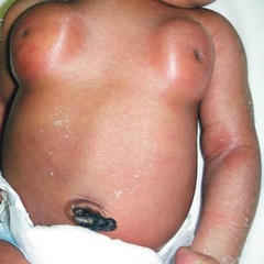 Мастопатия молочной железы у новорожденного лечение