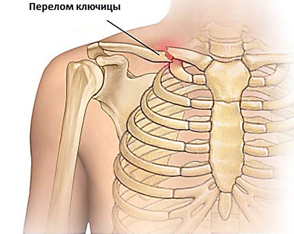 Открытый оскольчатый перелом локтевой кости. Перелом головки лучевой кости | ortoped-klinik.com Перелом локтевой кости (локтевого сустава) со смещением и без: симптомы. Оскольчатый перелом, причины, симптомы и лечение осколочного перелома