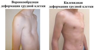 В норме грудная клетка может быть