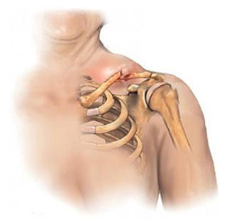 Фиксирующая повязка на руку при переломе ключицы у
