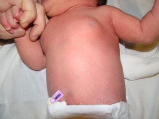 Ребенку 1 год на соске шишка