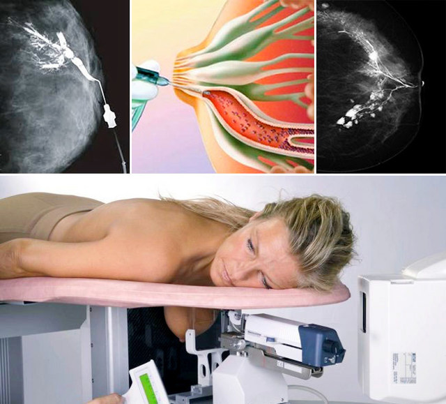 Маммография старый. Дуктография (галактография). Дуктография молочной железы. Контрастная дуктография что это. Рентгеновская маммография.