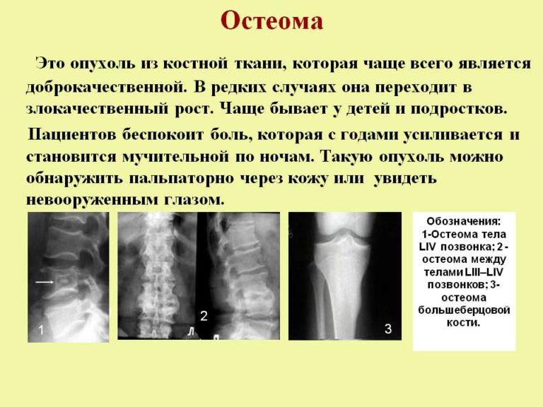 Остеосклероз подвздошной кости симптомы и признаки с фото