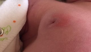Уплотнение в молочной железе у новорожденной девочки лечение thumbnail