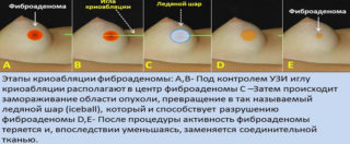 Лечение фиброаденомы молочной железы капустой