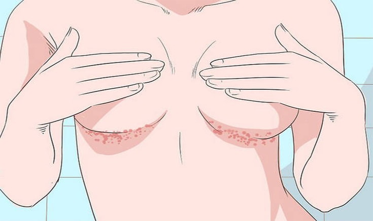 Способы профилактики и лечения грибка под грудью